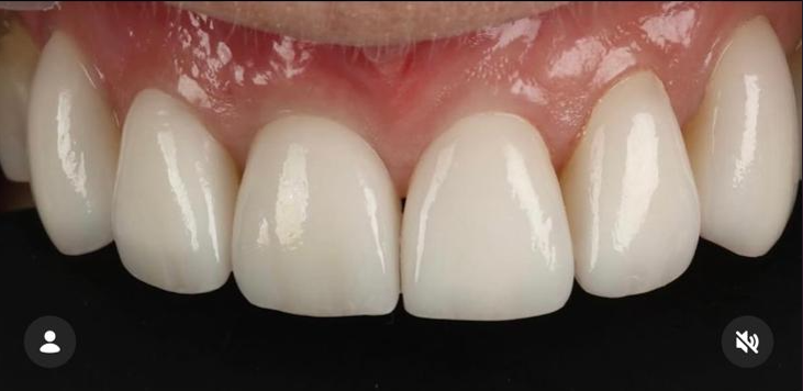 Single Implant after treatment